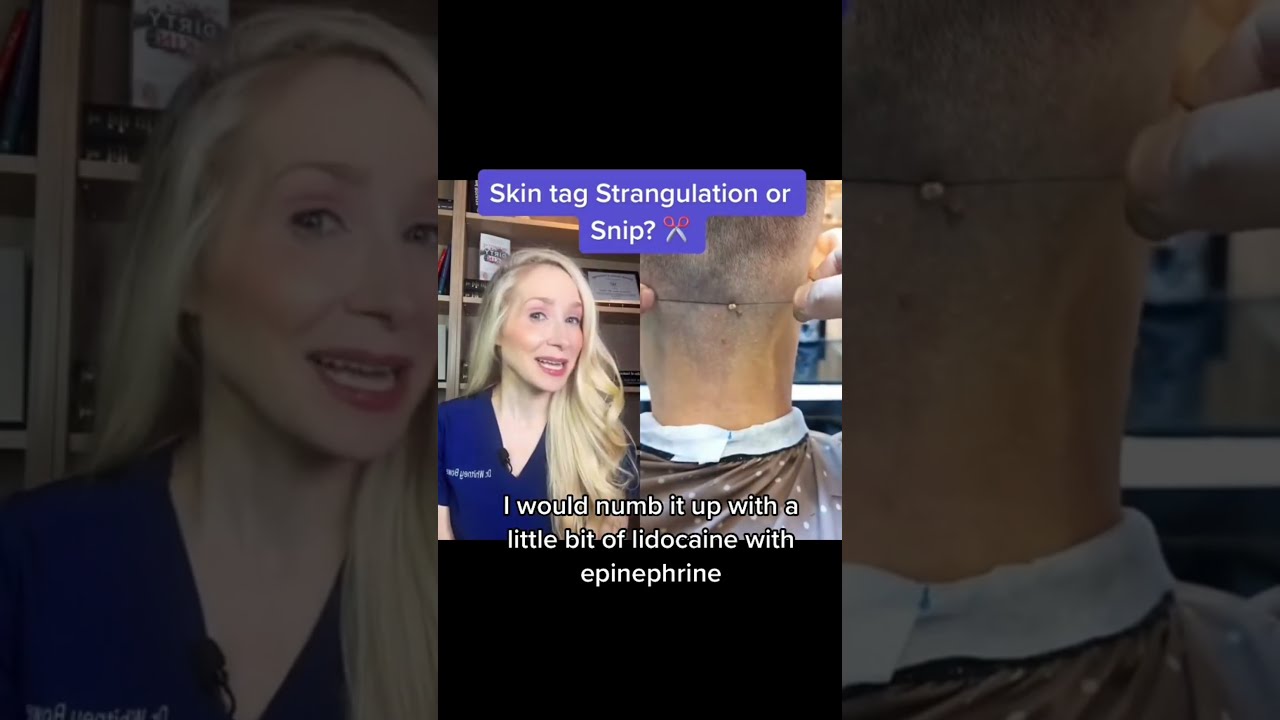 Dermatologist Reacts To Skin Tag Removal Shorts
