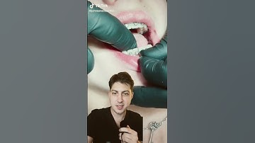 The TOOTH SAW! The ENAMEL DESTROYER! IPR for Invisalign and braces explained!