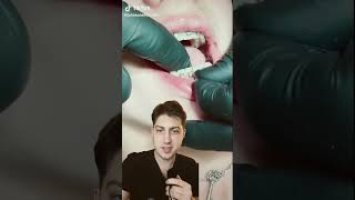 The TOOTH SAW The ENAMEL DESTROYER IPR for Invisalign and braces explained