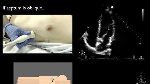 06. Apical 4-Chamber View