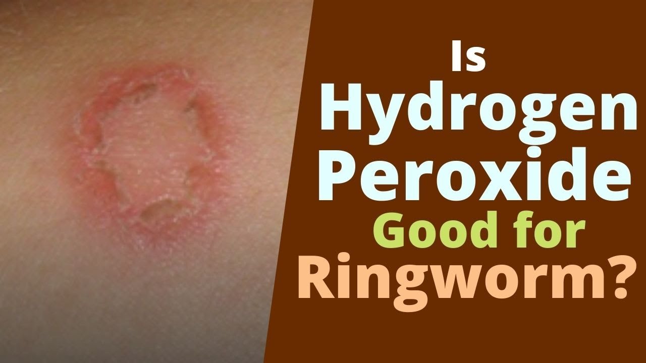 Ringworm rash: Pictures, treatments, and prevention