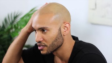 Joe Taylor Scalp Micropigmentation Hair Tattoo