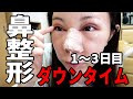 【閲覧注意】鼻中隔延長したからダウンタイム全部みせる【美容整形の現実】