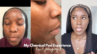 My Chemical Peel Experience (Purging) Before &amp; After | Jamila Nia