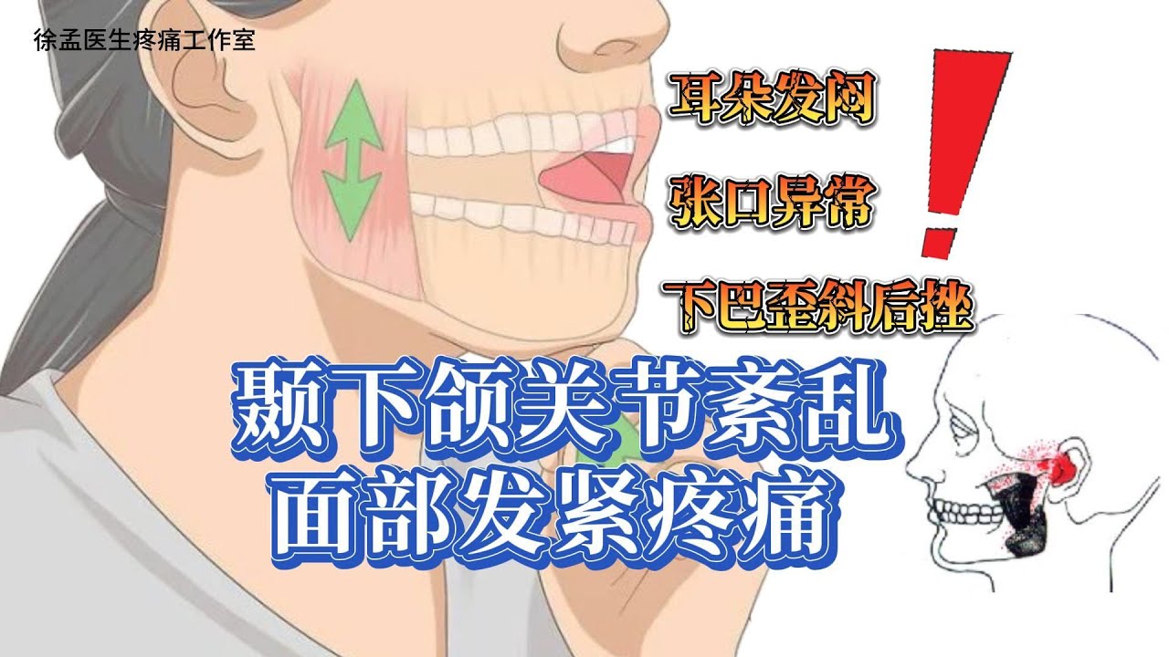 颞下颌关节紊乱、面部发紧疼痛、耳朵发闷、张口异常、下巴歪斜后挫 - YouTube