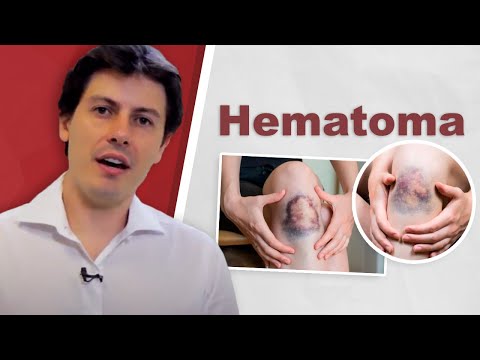 Vídeo: Os hematomas são duros ou moles?