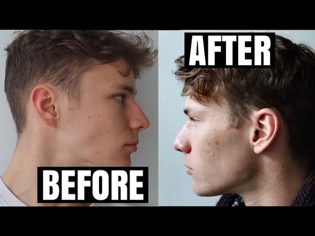 I trained my JAW every day for 30 days and this happened…. 