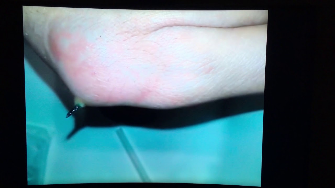 Гнойная заноза! Прыщ! Чёрные точки! Acne! Purulent splinter - YouTube