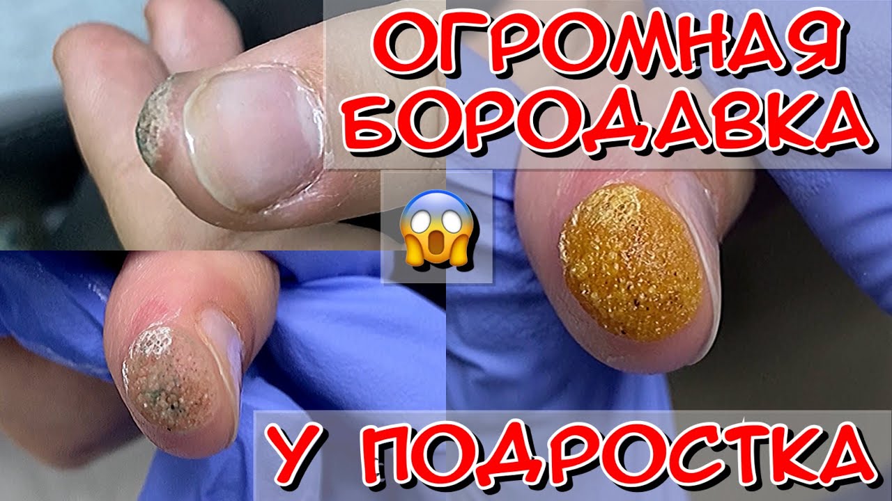 Огромная бородавка у подростка / бородавка на пальце - YouTube
