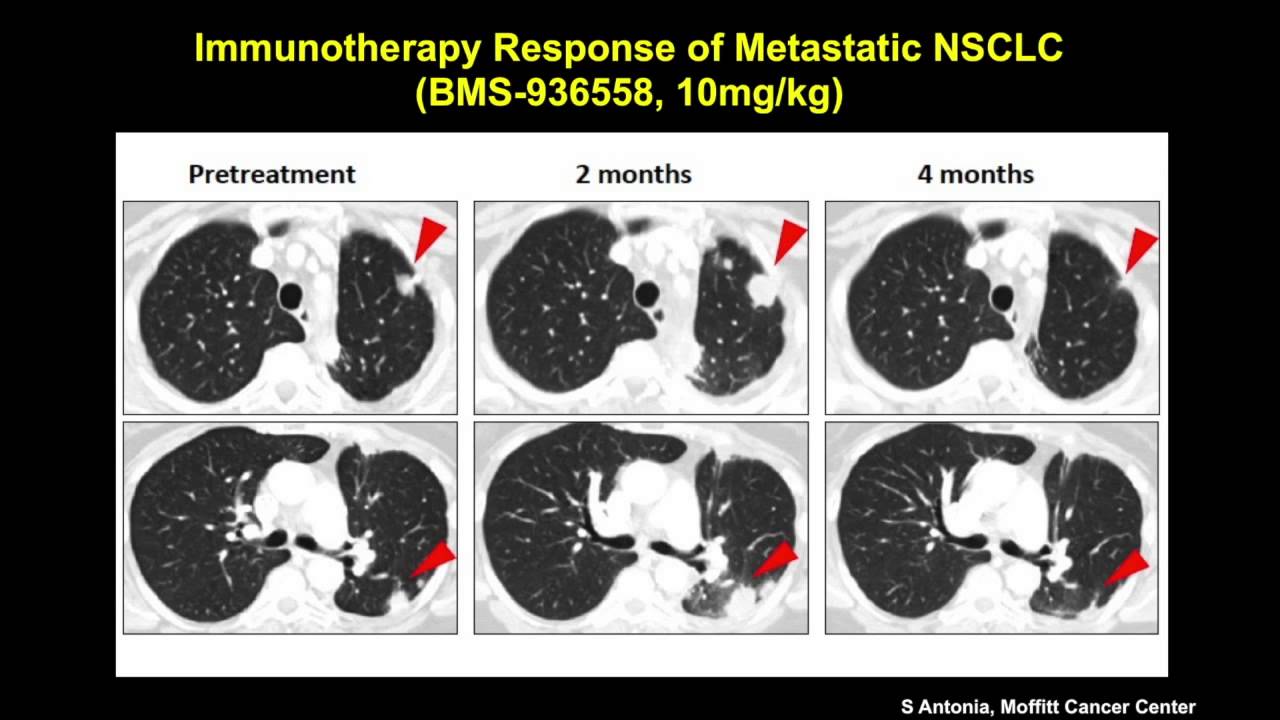 Advances in Lung Cancer Treatments YouTube