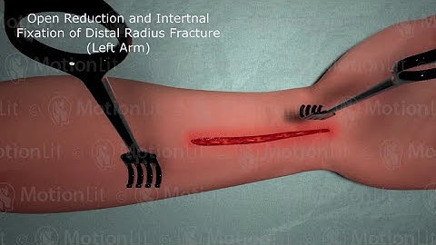Left Arm ORIF Procedure of Distal Radius Fracture - 3D Medical Animation