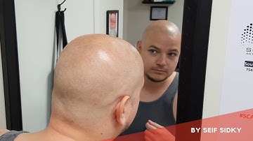 Scalp Micropigmentation - Get Back Your Confidence