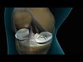 Torn Knee Meniscus Repair