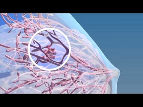 Breast Cancer - 3D Medical Animation || ABP ©
