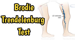 Brodie–Trendelenburg Test | Venous Insufficiency | Diagnosis Of Varicose Veins |