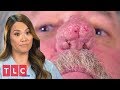 This Patient Can Barely Breathe Through His Nostrils | Dr. Pimple Popper