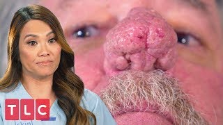 This Patient Can Barely Breathe Through His Nostrils | Dr. Pimple Popper This Patient Can Barely Breathe Through His Nostrils | Dr. Pimple Popper