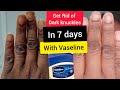 How to LIGHTEN Dark Knuckles Fast With VASELINE In (7 Days)