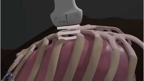 3D How To Lung Sliding Detection with Linear Transducer