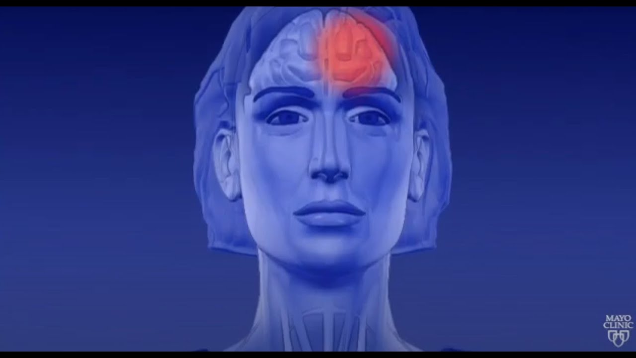 Migraine - Symptoms and causes - Mayo Clinic