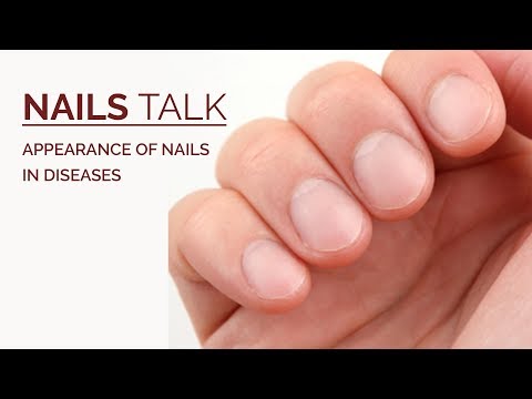 Video: Terry's Nails: Slike, Uzroci, Liječenje, Vs. Lindsay's Nails