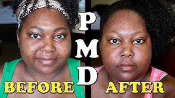 PMD (Personal Microderm) Review and Demo