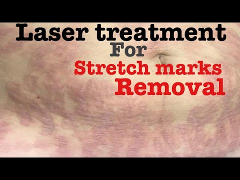 Laser treatment for stretch marks | स्ट्रेच मार्क्स को कैसे हटाये ।