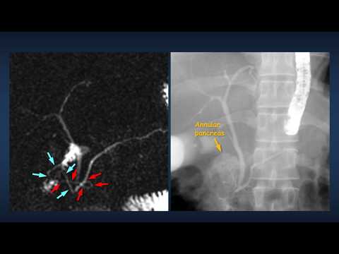 Tracing the intriguing duct of annular pancreas by CT and MRI
