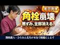 【角栓崩壊】毛穴洗浄で溜まった角栓をごっそり吸引。ハイドラジェントルの効果
