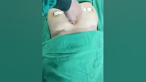 Nâng ngực nội soi - Sự thay đổi hoàn toàn của bà mẹ 3 con tại thẩm mỹ DRD