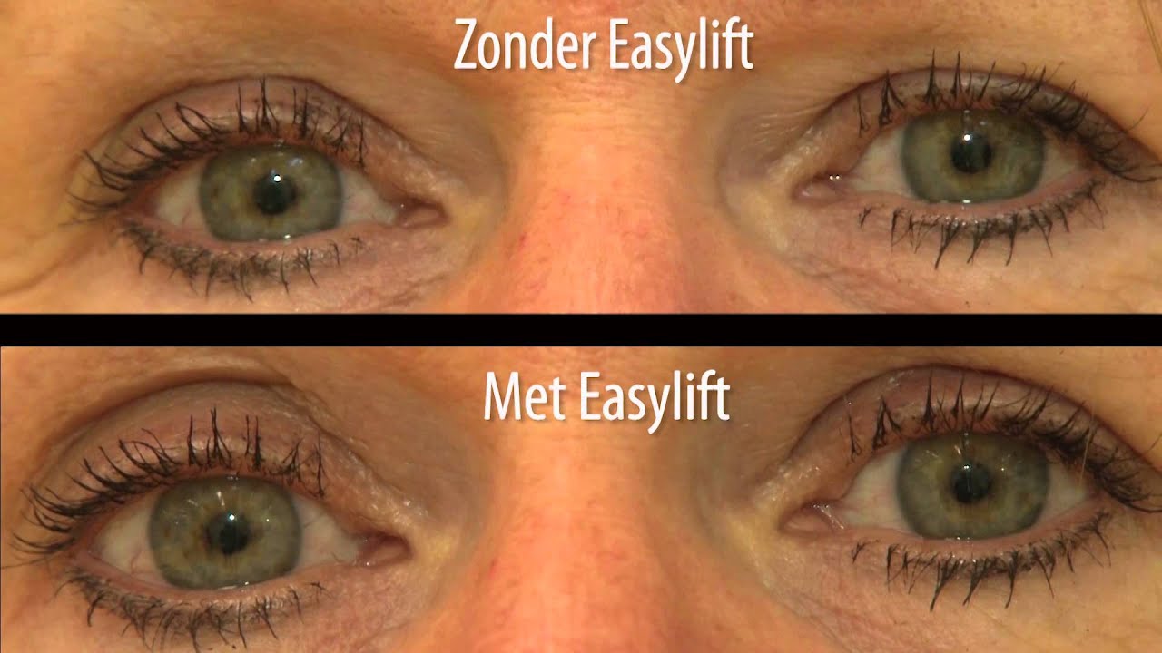 Ooglidcorrectie consumentenbond