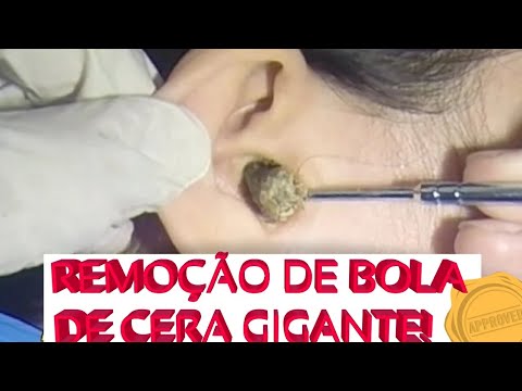 Remoção De Cera De Ouvido GIGANTE|| Giant Wax Removal OMG!