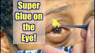 What Do You Do if You Get Glue in Your Eyes?