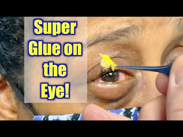 What Do You Do if You Get Glue in Your Eyes?