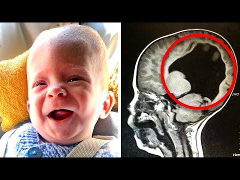 Video: Ein Junge Ohne Gehirn Wurde Vor Sieben Jahren Geboren. Was Ist Mit Ihm Passiert Und Wie Lebt Er Heute - Alternative Ansicht