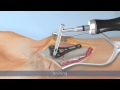 Ixos® Radius plate system P4 Wave – Surgical technique