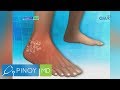 Pinoy MD: Posible bang magka-gout sa edad na 22?