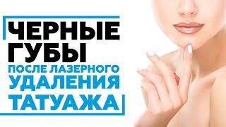 Чернеют ли губы после лазерного удаления татуажа? #удалениетатуажа #татуажгуб(, 2017-05-09T18:38:08.000Z)
