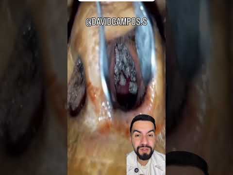 LARVA EN LA NARIZ