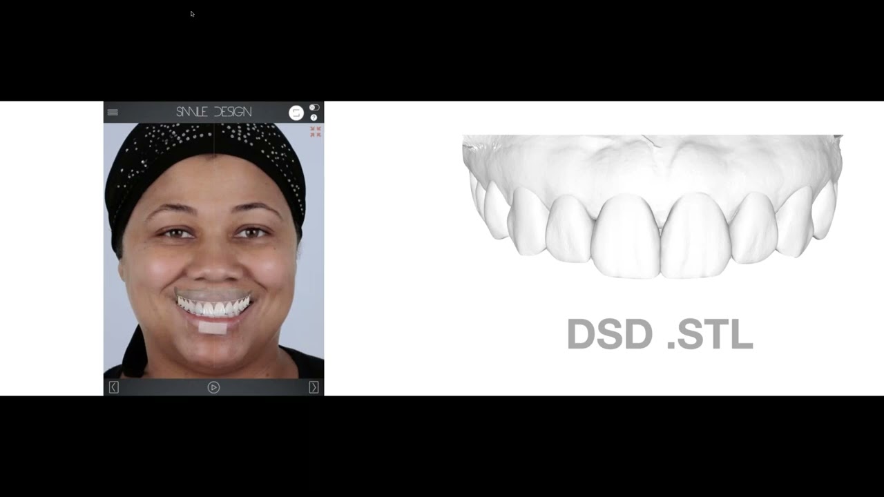 Porcelain Laminate Veneers ReLearning A Proven Successful Technique