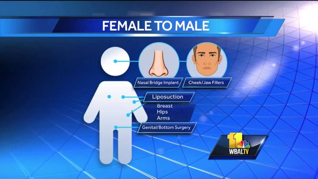 Video Female To Male Sex Reassignment Surgery Explained The 