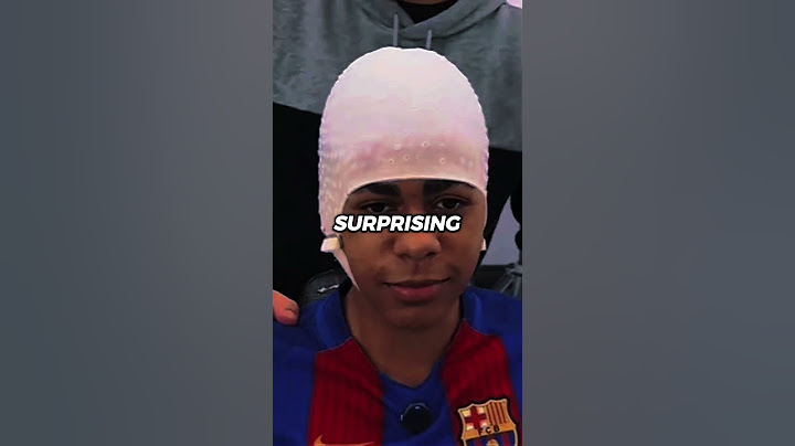 The real reason Lamine Yamal always hides his forehead. 😳😞