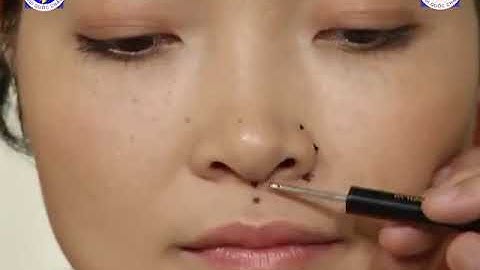 GS TSKH Bùi Quốc Châu Hướng Dẫn Trị Chứng Nấc Cụt Bằng Diện Chẩn