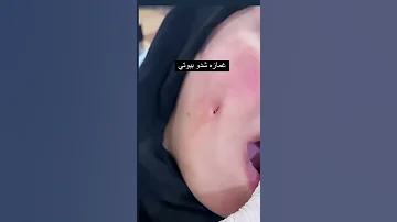 عمل غمازه 