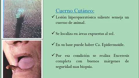 ¿Qué son las lesiones cutáneas precancerosas?