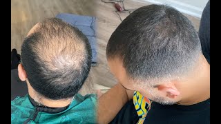 MAJOR Transformation | How to Fade Balding Hair & Apply Hair Fibers