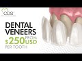 What Are Dental Veneers And How Much Do They Cost? | Cosmetic Dentistry