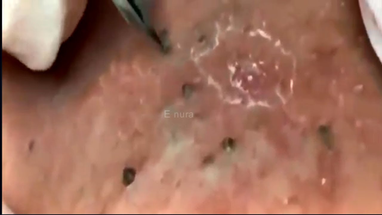 blackhead extractions new remove blackheads dermatologist 35 YouTube