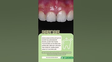 Răng sứ kiểu răng thỏ được đông đảo giới trẻ yêu thích và lựa chọn #nhakhoa  #xuhuong #danang #teeth