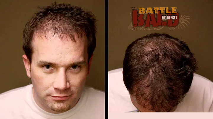 Hair Transplant Results - 12 Month Time-lapse Befo...